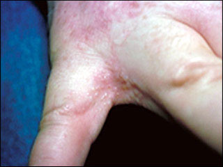 Dyshidrotic eczema