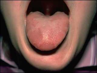 Geographic tongue