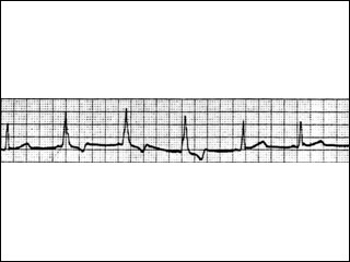 Electrocardiogram of Wolff-Parkinson-White syndrome