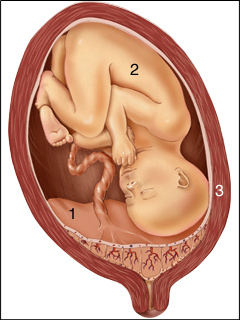 Placenta previa