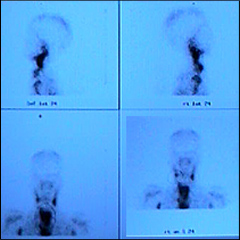 Abscess scan with radioactive dye