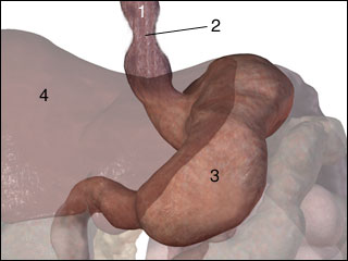 Stricture of the esophagus