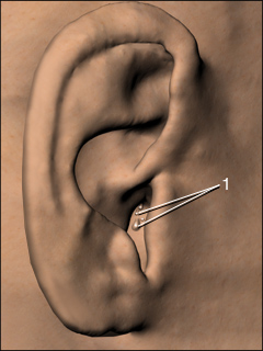 Ear polyps