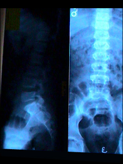 Lumbosacral spine X-ray