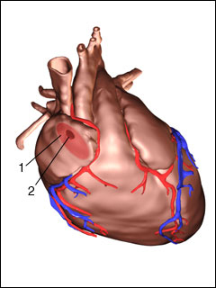 Patent foramen ovale