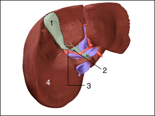 Gallbladder removal (cholescystectomy)