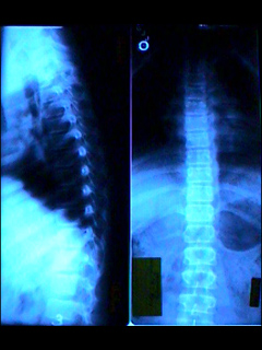 Thoracic spine X-ray