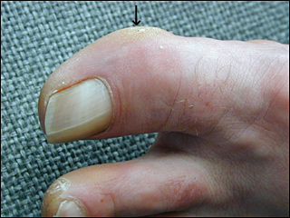 Corns and Calluses