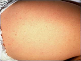 Roseola