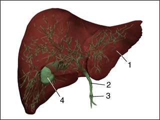 Gallstones in the common bile duct (choledocholithiasis)