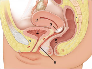 Diaphragm