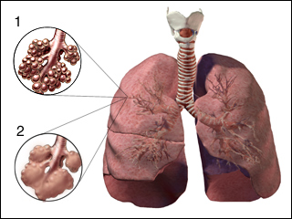 Emphysema