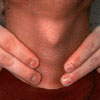 Thyroid disease - Underactive